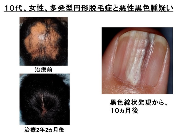 円形脱毛症　病院